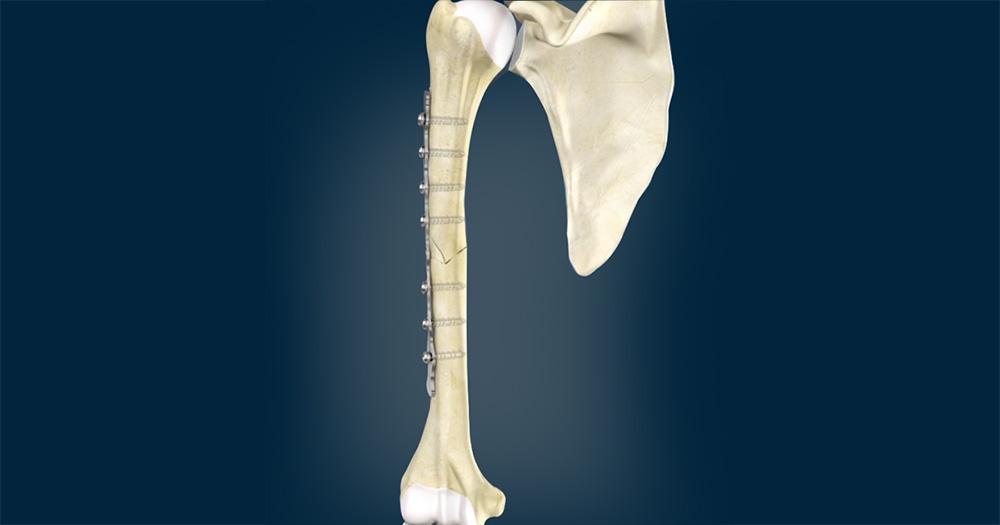 How Open Reduction and Internal Fixation Treats Fractures