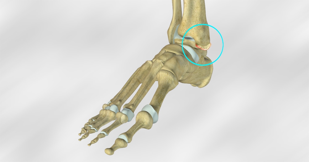 Just Diagnosed with Ankle Impingement? Here