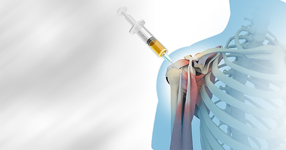 PRP Injections for Arthritis: What to Expect