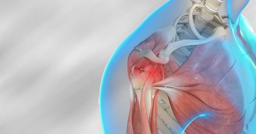 Tips for Returning to Sports After a Rotator Cuff Tear