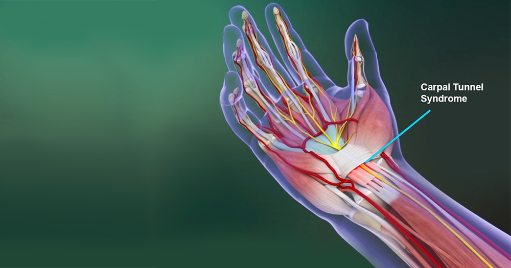 Tips to Work a Hands-On Job with Carpal Tunnel