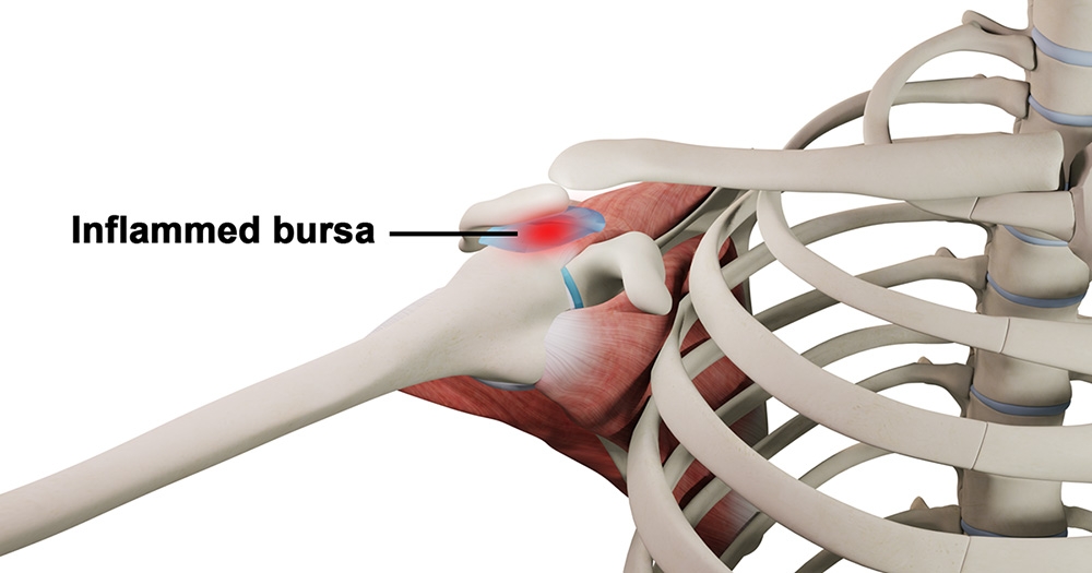 What to Do When Shoulder Pain Disrupts Sleep