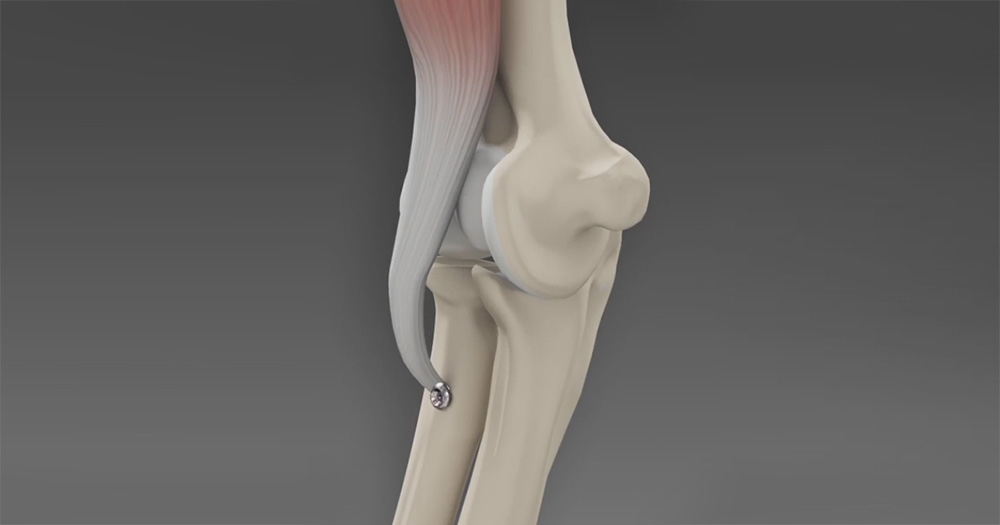 What to Expect After Bicep Tendon Repair