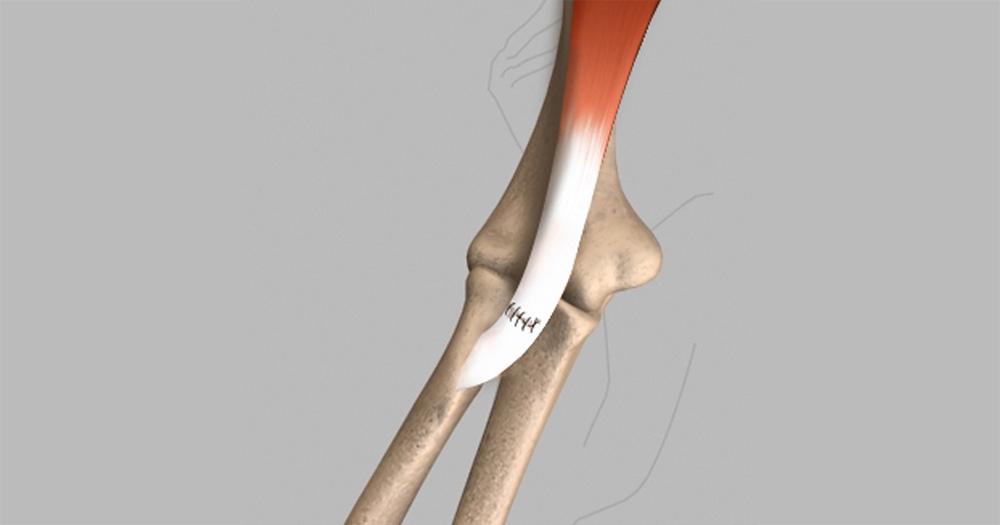 What to Expect Before, During, and After Bicep Tendon Repair