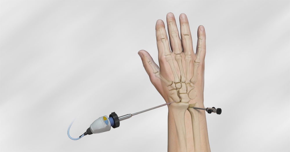 Wrist Arthroscopy Recovery: What to Expect